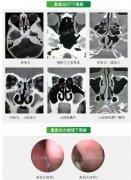 鼻窦炎不治疗会有哪些危害