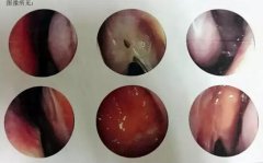 萎缩性鼻炎检查和治疗—访仁品耳鼻喉鼻科医生