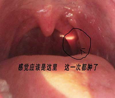 喉咙部位有异物感怎么办