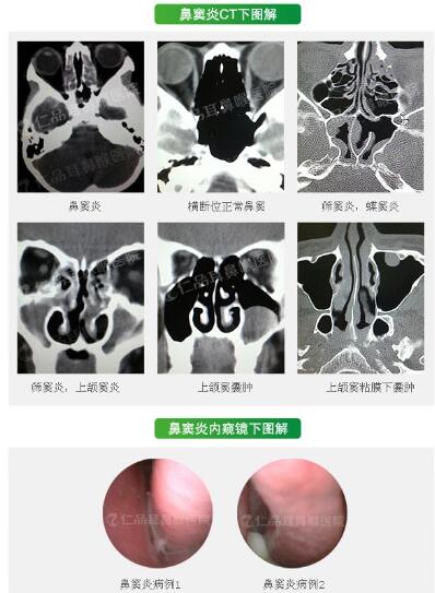 鼻窦炎CT图解.jpg