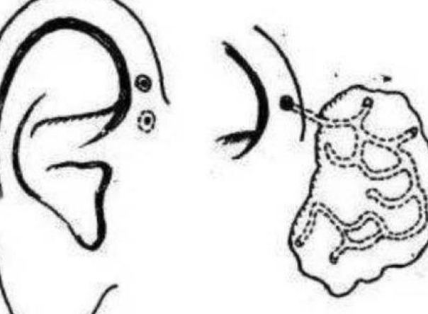 耳前瘘管的危害有哪些